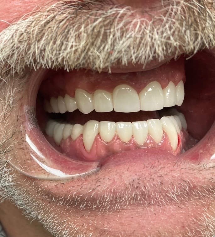 After Treatment Smile